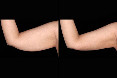 BodyTite Arms before and after